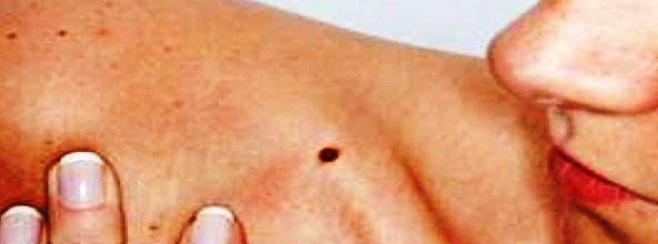 cancer-a-la-piel-portadaok